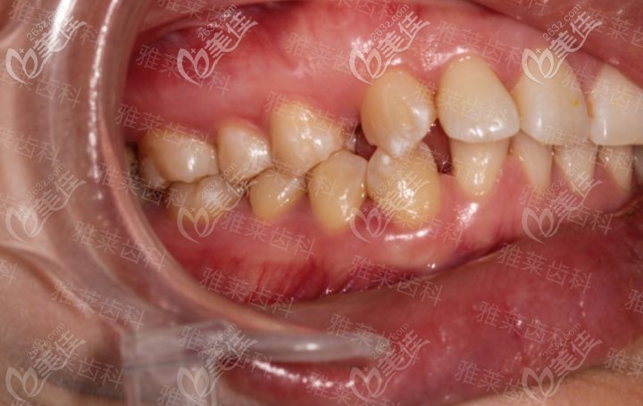 杭州雅萊紀亞梅時代天使矯正前