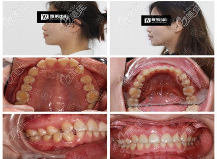 紀亞梅時代天使隱形矯正案例