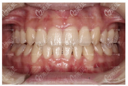 28歲牙弓狹窄戴隱適美矯正26個(gè)月后上下牙咬合正常,笑起來(lái)真好看！