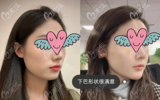 下頜緣凹陷填充脂肪30天變化對(duì)比照片