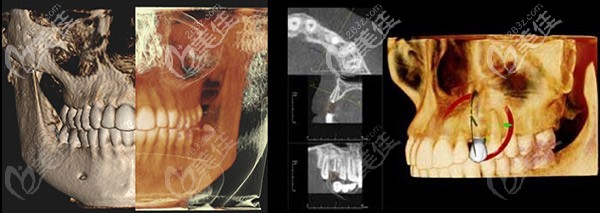 數(shù)字化精準(zhǔn)矯正技術(shù)