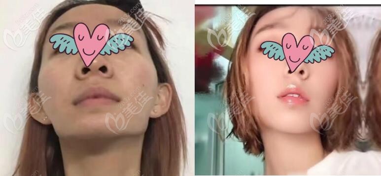 下頜角切多了填充人工骨修復(fù)一年效果對(duì)比圖