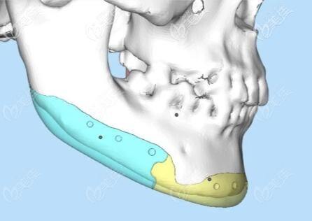 人工骨補(bǔ)下頜角安全性介紹