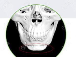 下頜角切多了危害