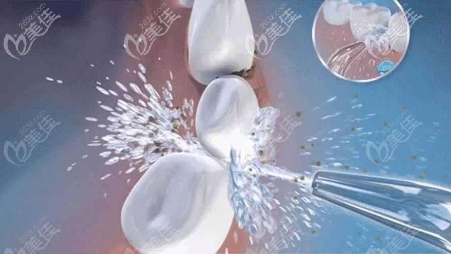 超聲波潔牙 超聲波潔牙