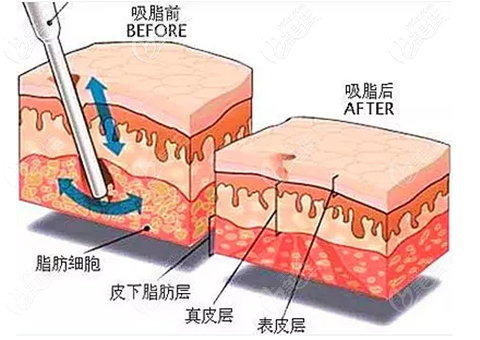 富貴包抽脂原理