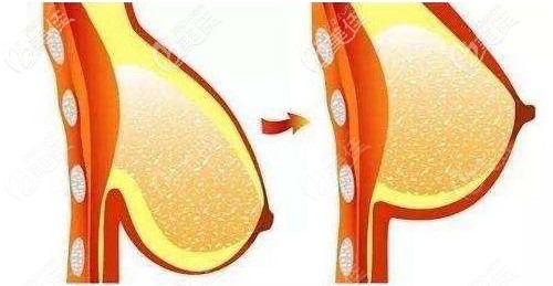 本身胸大還下垂的情況