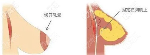 胸部乳房懸吊線(xiàn)斷了