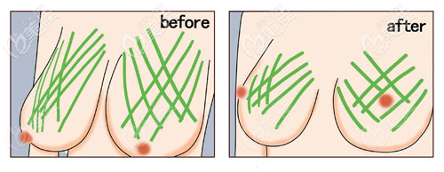 乳房懸吊手術(shù)方法