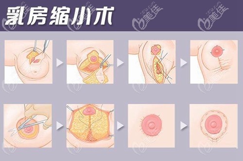 乳暈切口乳房縮小手術(shù)方法