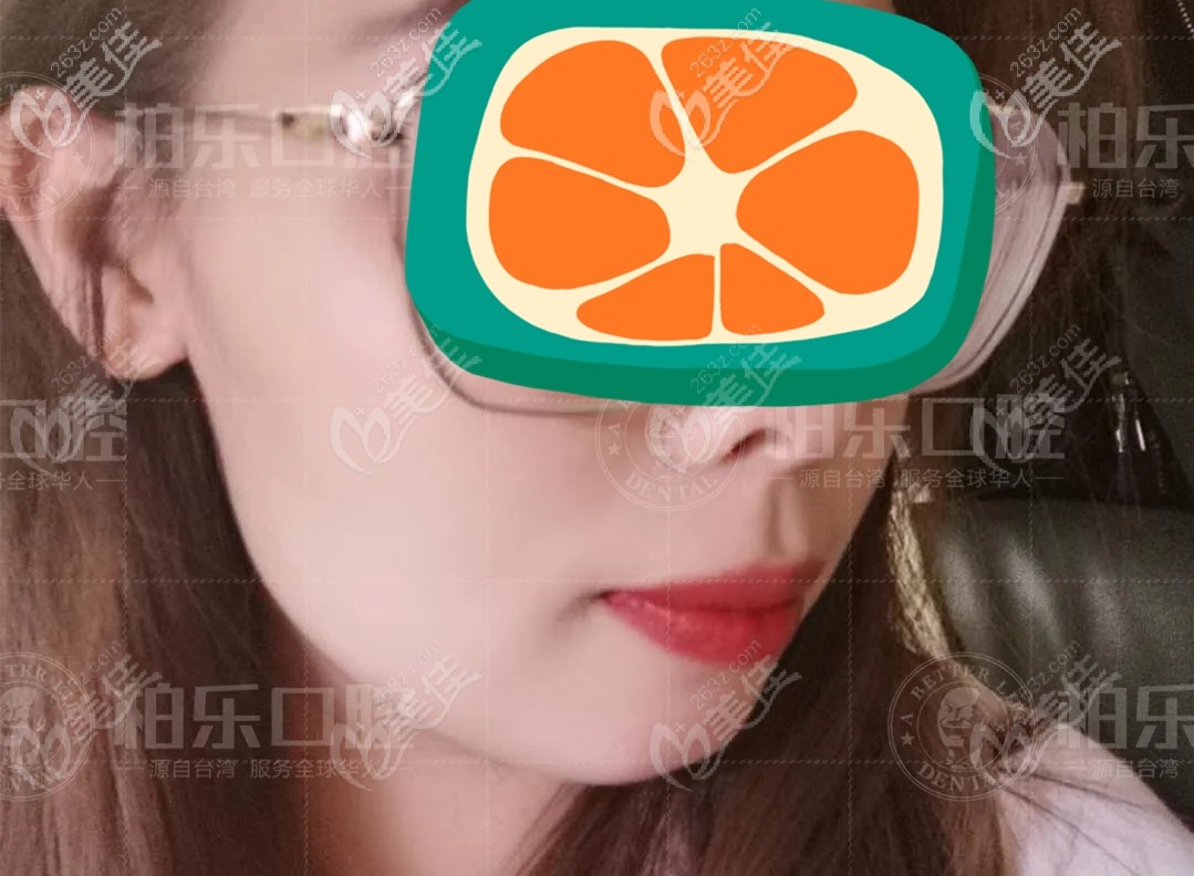 矯正中臉型 矯正中臉型