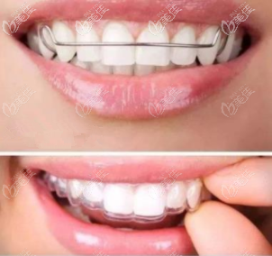 哈雷保持器和透明保持器差別