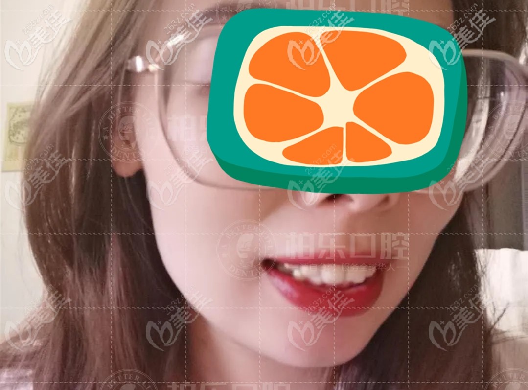 隱適美推磨牙向后矯正深覆合一點(diǎn)也不后悔,來看我做天包地矯正后臉型變化圖吧