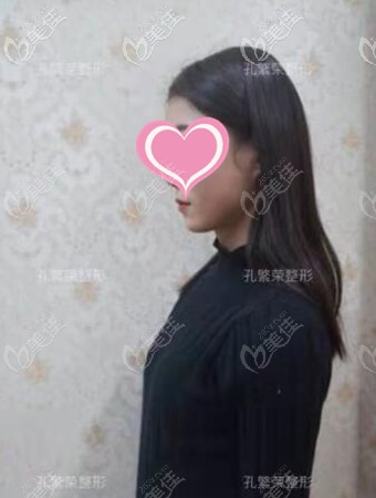 假體隆胸術(shù)前 假體隆胸術(shù)前