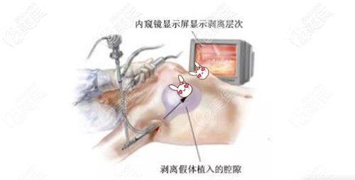 內(nèi)窺鏡豐胸手術(shù)過(guò)程不疼 內(nèi)窺鏡豐胸手術(shù)過(guò)程不疼