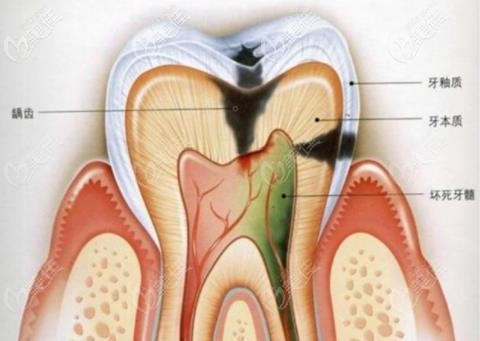 初期盡量保留活髓 初期盡量保留活髓