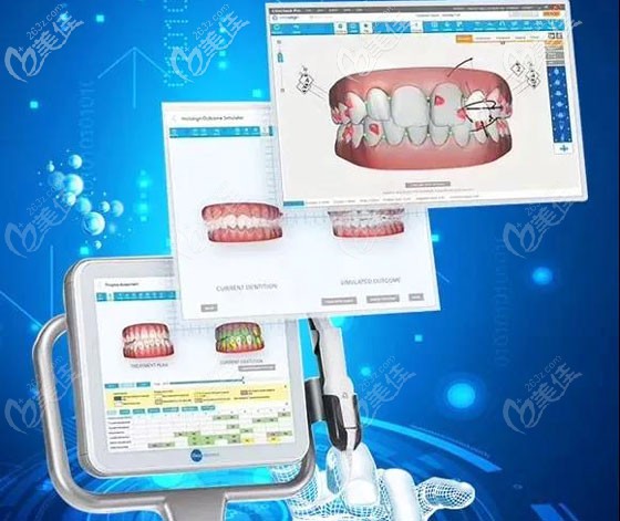 隱適美iTero口掃的掃描流程