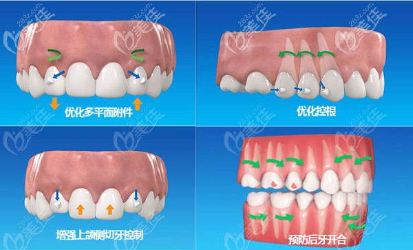 隱適美itero口腔掃描的效果圖