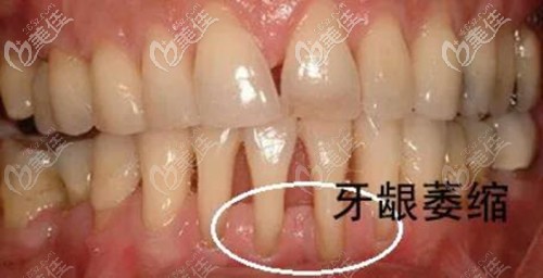 牙齦萎縮的圖片
