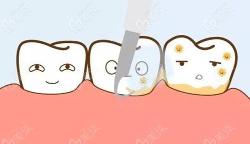 齦下刮治的方法