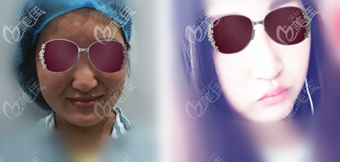 鼻子奧美定取出40天的恢復(fù)效果