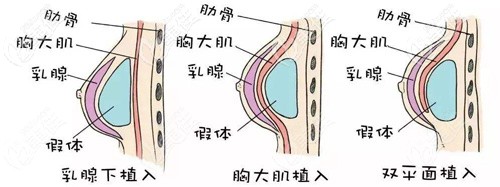 徐院長(zhǎng)做假體隆胸的示意圖