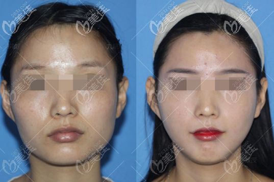 顴骨內(nèi)推+下頜角長曲線截骨效果圖