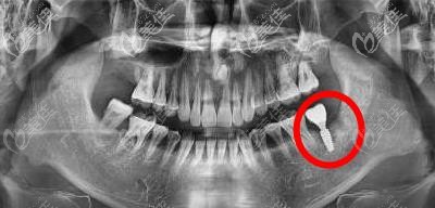 牙槽骨吸收了還可以種植牙 牙槽骨吸收了還可以種植牙