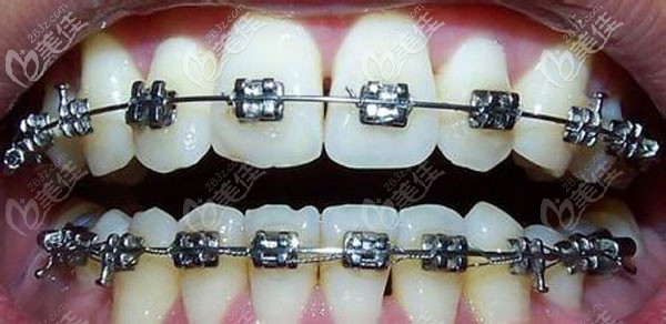 牙齒正畸中有蛀牙該怎么辦，還能治療嗎