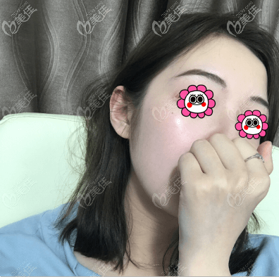 做光子嫩膚一個(gè)月了？