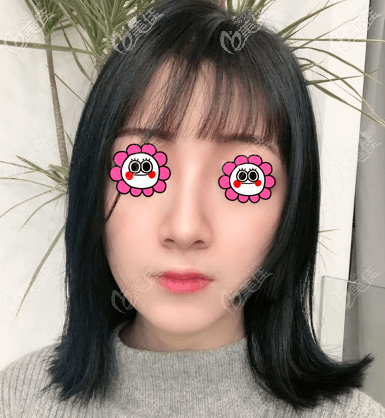 M22光子嫩膚后肌膚緊致有彈性