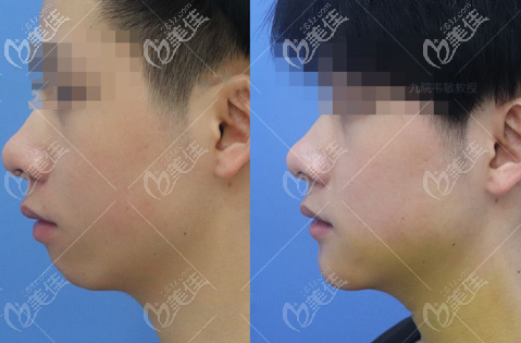 男士下頦成型手術(shù)對比照片 男士下頦成型手術(shù)對比照片