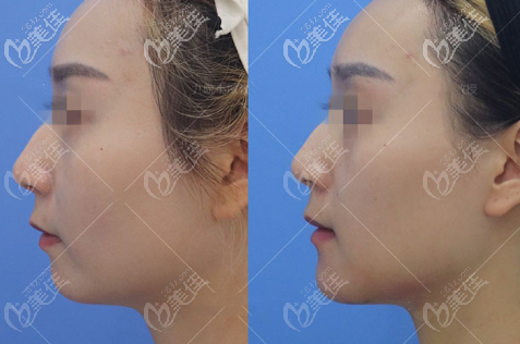 女士下頦成型手術(shù)側(cè)面對比照片 女士下頦成型手術(shù)側(cè)面對比照片
