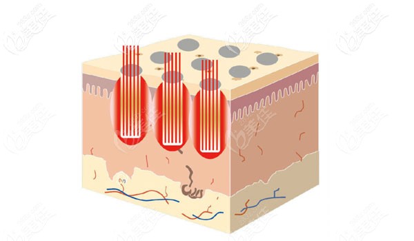 點陣激光去除剖腹產(chǎn)疤痕多久能見效 點陣激光去除剖腹產(chǎn)疤痕多久能見效