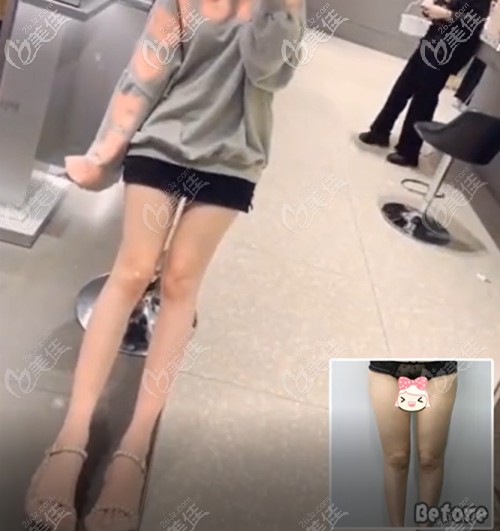 猜猜我找成都程紅濤做的大小腿吸脂是多久恢復(fù)的?腿部吸脂恢復(fù)期短的原因在這