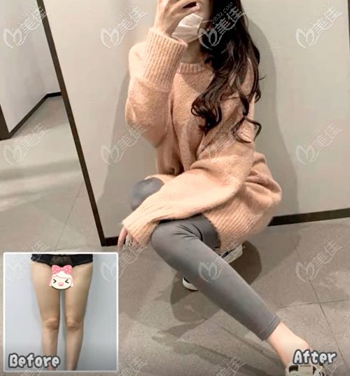 成都艾米麗整形美容醫(yī)院腿部吸脂案例效果 成都艾米麗整形美容醫(yī)院腿部吸脂案例效果