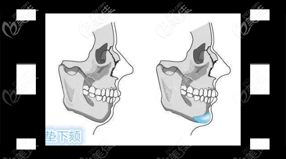假體隆頦手術(shù) 假體隆頦手術(shù)
