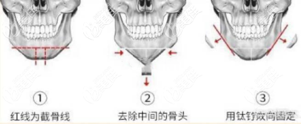 頦成型手術(shù) 頦成型手術(shù)