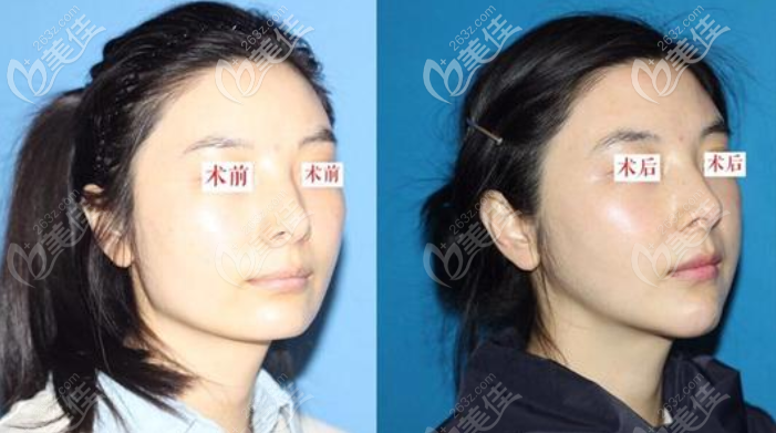 下頜角頦成形手術(shù)術(shù)前術(shù)后對(duì)比照片 下頜角頦成形手術(shù)術(shù)前術(shù)后對(duì)比照片
