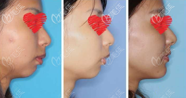 下巴后縮頦成型前移1厘米效果圖 下巴后縮頦成型前移1厘米效果圖