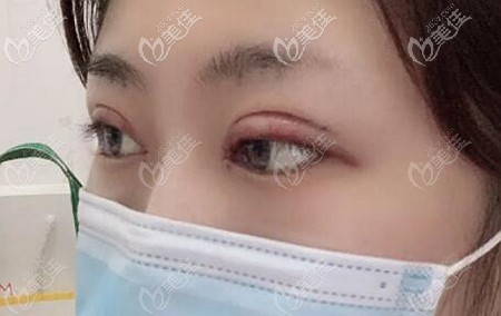 做眼綜合后會(huì)有腫脹期