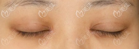 做完眼綜合后疤痕不明顯
