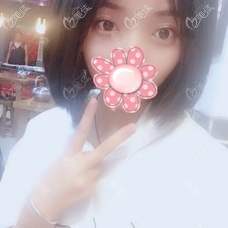 新鄉(xiāng)朋友發(fā)來了她找張紅亮做眼綜合后10天、40天和60天的恢復圖