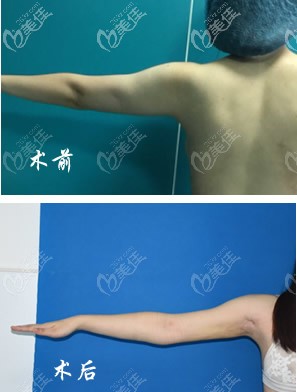 我手臂抽脂前后對比照片