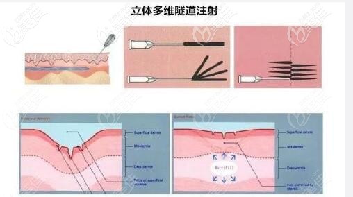 液態(tài)提升面部原理示意圖 液態(tài)提升面部原理示意圖