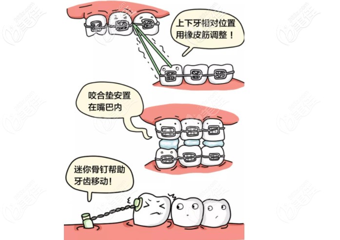 托槽掉落不粘是會影響矯正周期的哦