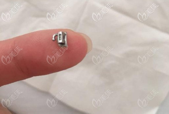 如何防止托槽掉落