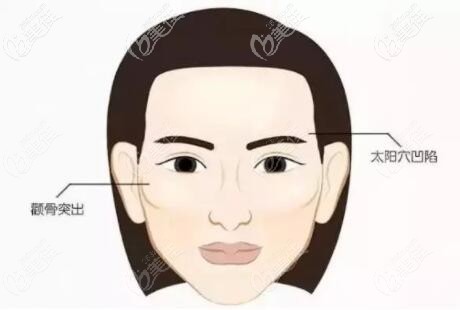 顴骨內(nèi)推適合多大年齡做
