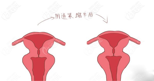 陰道緊縮術(shù)前術(shù)后對(duì)比示意圖