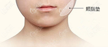 頰脂墊具體位置示意圖 頰脂墊具體位置示意圖